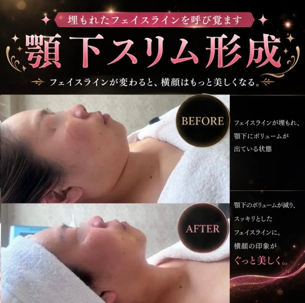 ✨顎下スリム形成✨