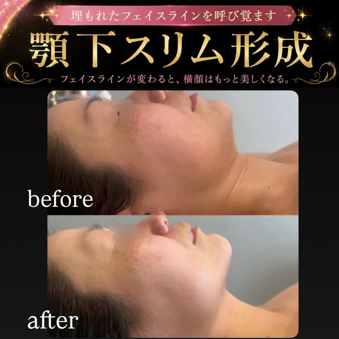 ✨顎下スリム形成✨