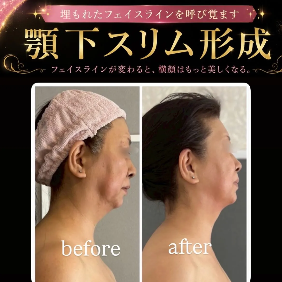 ✨顎下スリム形成✨